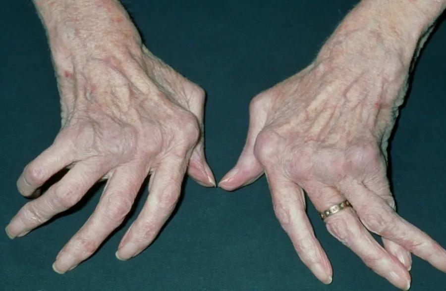 释疑解惑掀开羟氯喹的神秘面纱,氯喹和氯喹啉的作用