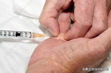 手掌腱膜挛缩不手术会怎样发展,头帽状腱膜挛缩症最新治疗方法