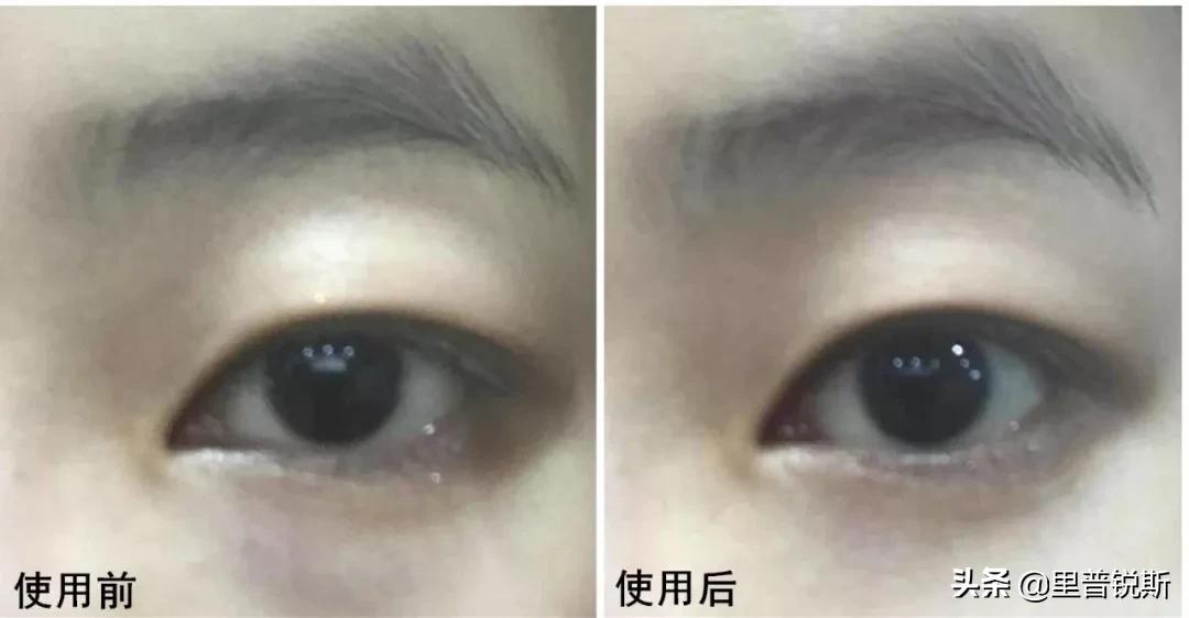 祖传药膏去除眼袋,祖传治疗眼袋