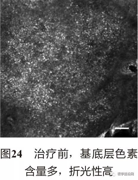 皮肤共聚焦显微镜能查什么,皮肤镜和共聚焦显微镜