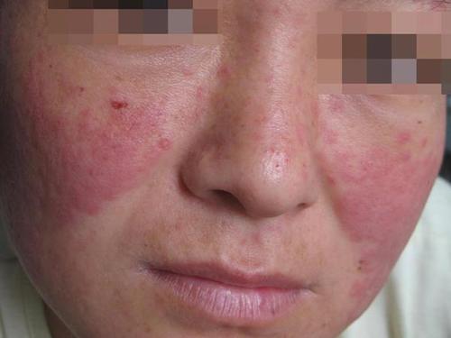 关于风湿病你了解多少,带您了解风湿病