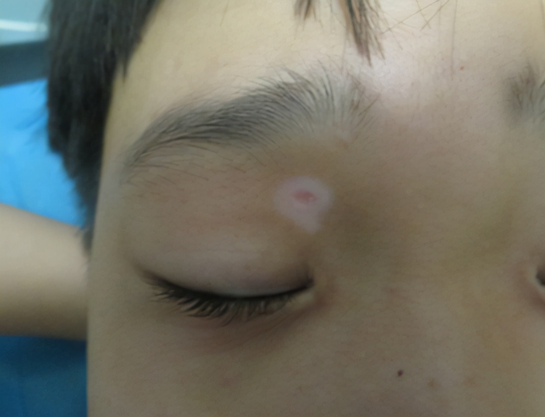 村里人说这个痣非“凶”即“淫”，吓得妈妈赶紧带孩子去点痣