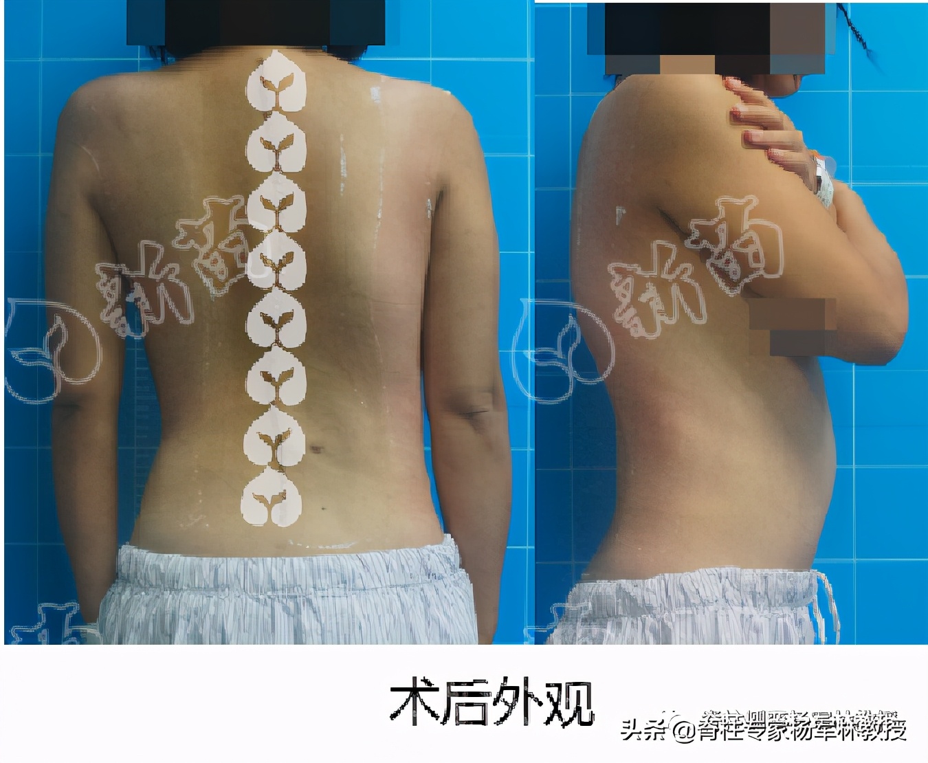 女高中生脊柱侧弯治疗视频,15岁女生脊柱侧弯能自愈吗