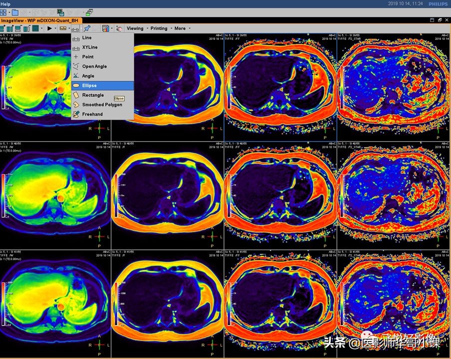 飞利浦磁共振快速扫描方案指南,飞利浦1.5t磁共振各部位扫描技术