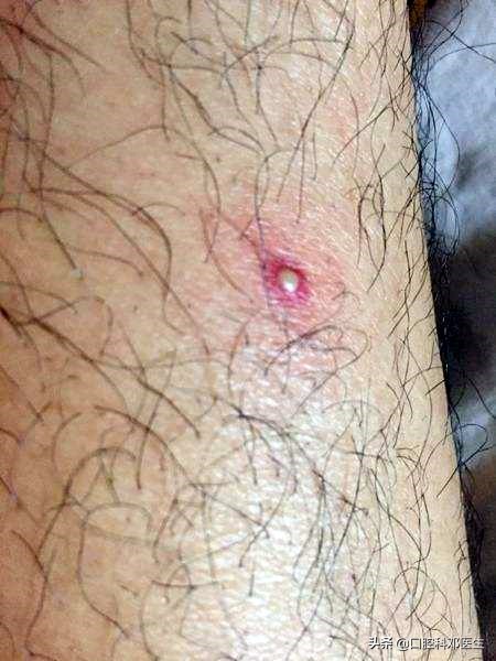 有一种口腔溃疡别忽视，可能是白塞病，病情一定要如实交代！