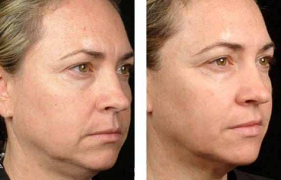 超声刀热玛吉都是什么仪器,医美小课堂热玛吉和超声刀区别