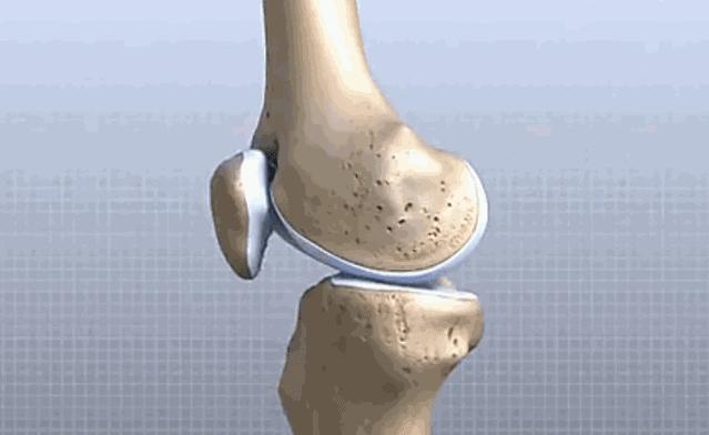 年轻人髌骨软化能不能恢复,年轻人的髌骨软化症是残废了吗