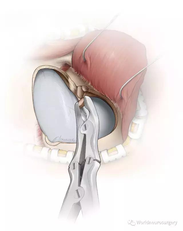 翼点入路技巧图解,翼点入路的开颅要点