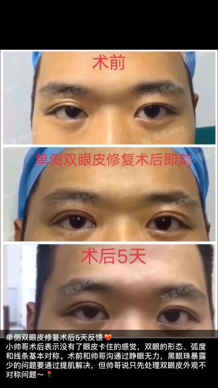双眼皮失败的女孩,双眼皮失败做成了三眼皮好修复吗