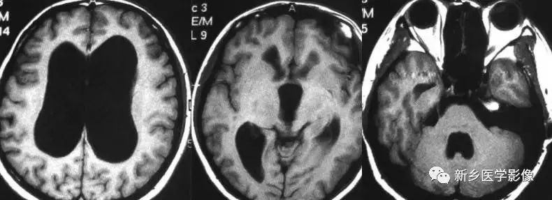 脑室影像学表现,脑室占位影像