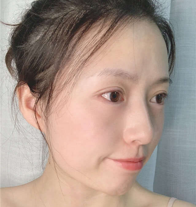 痘痘痒怎么办最有效的方法,去红肿痘痘最快方法