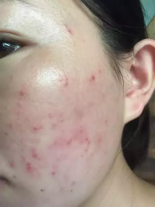 夏季常见皮肤病大片红肿,治不好的妇科病皮肤病有哪些