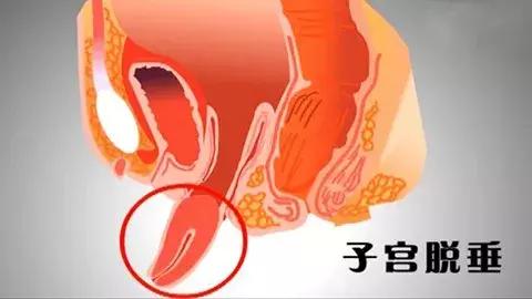 如果产后没做康复该怎么办,产后不注意什么会让子宫下垂