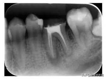 牙科拍片有多大危害?儿童和孕妇可以拍牙片吗?让牙匠周来捋一捋