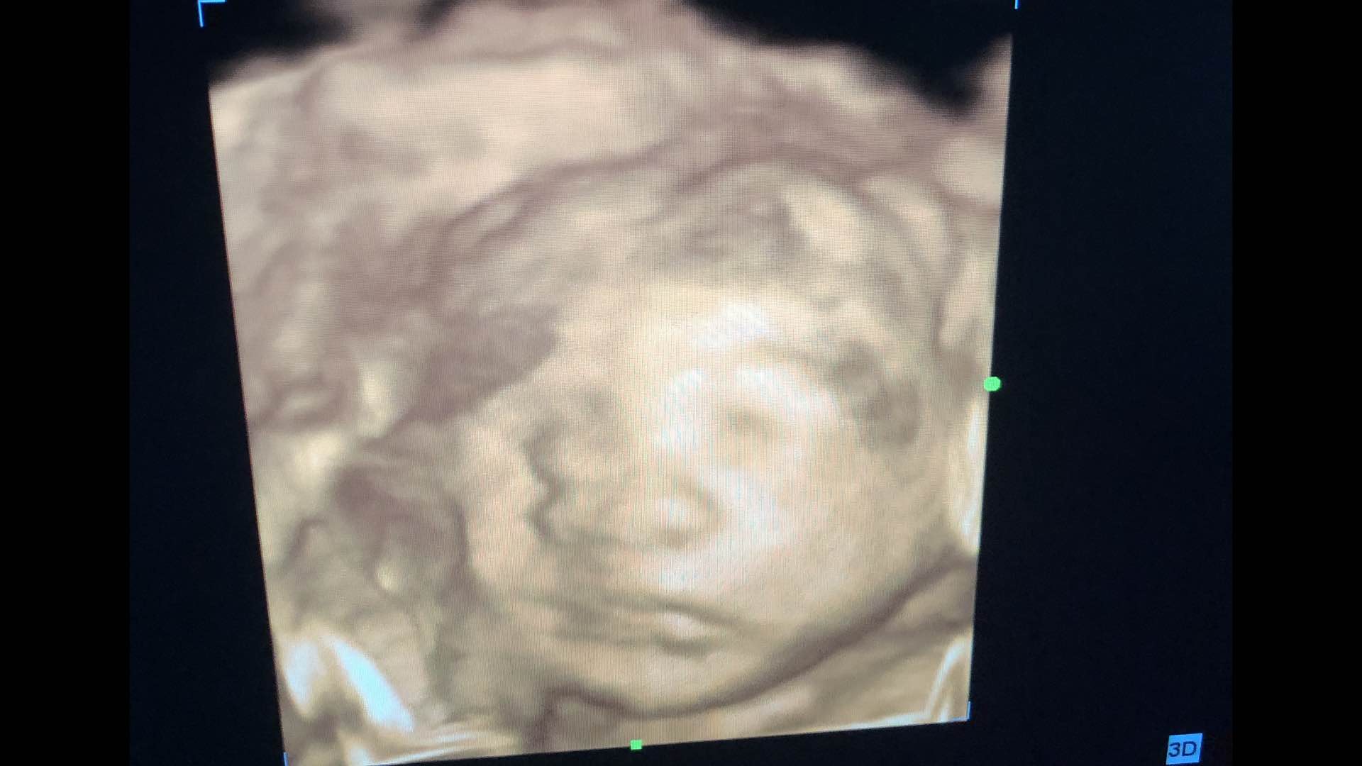 孕34周+3,分享一下整个孕期的检查吧