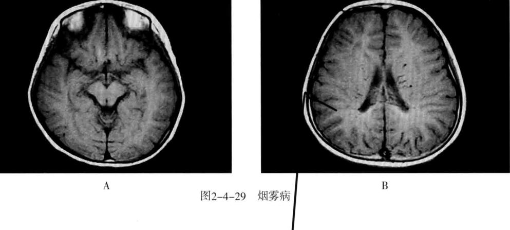 颅内血管轻度狭窄诊断标准,颅内血管先天变异影像