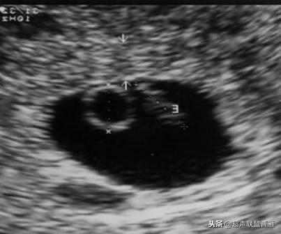 内见卵黄囊,卵黄囊肿瘤
