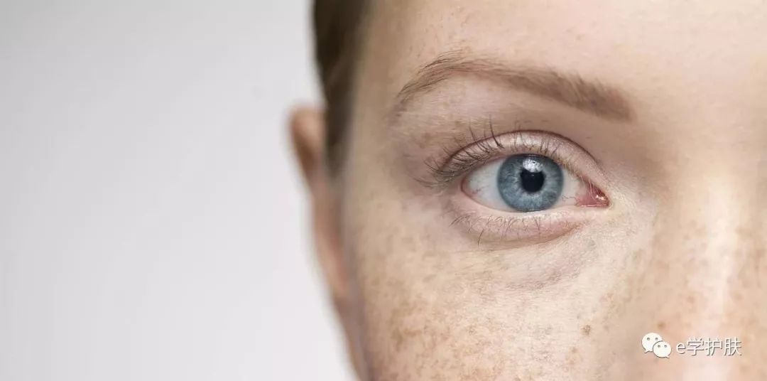 痘印和色斑怎么区别,痘印和斑点肌肤怎么护理