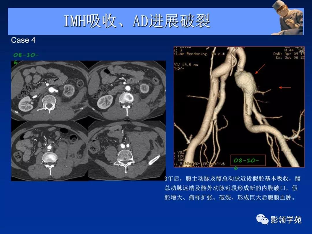 主动脉夹层壁间血肿如何鉴别,主动脉夹层血肿溃疡