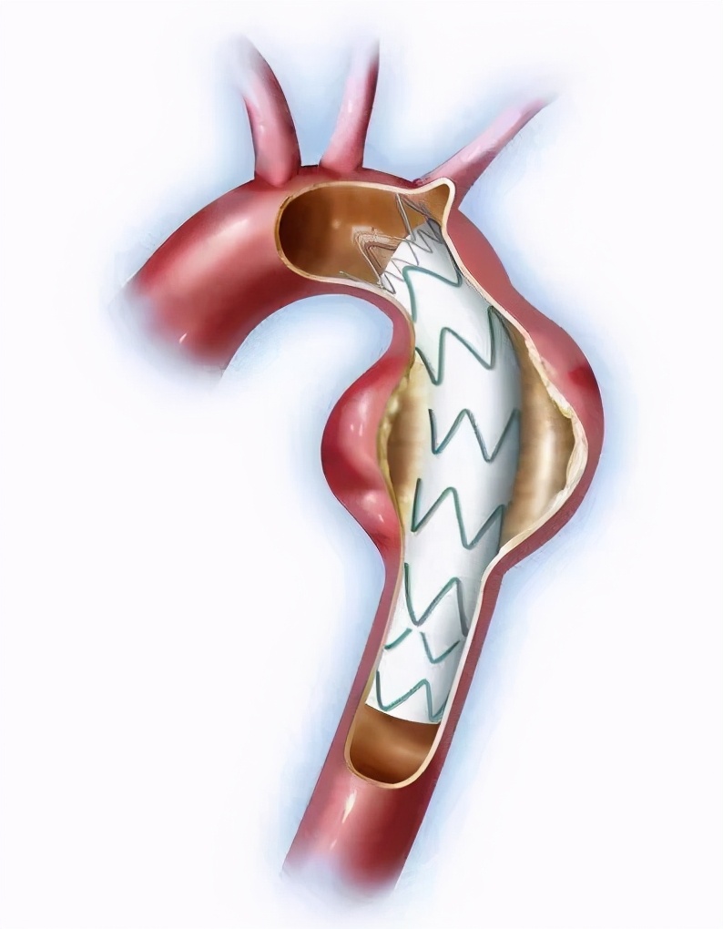 小伙被感染梅毒,晚期梅毒可能造成肺部损伤吗