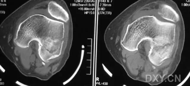 所有骨折都叫什么名字,骨折的名称有哪些
