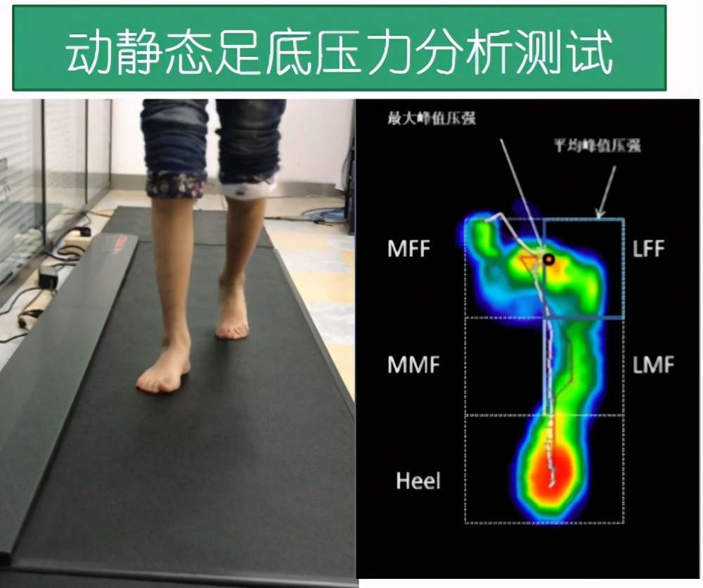 矫形鞋垫前后对比,矫形鞋和矫形鞋垫