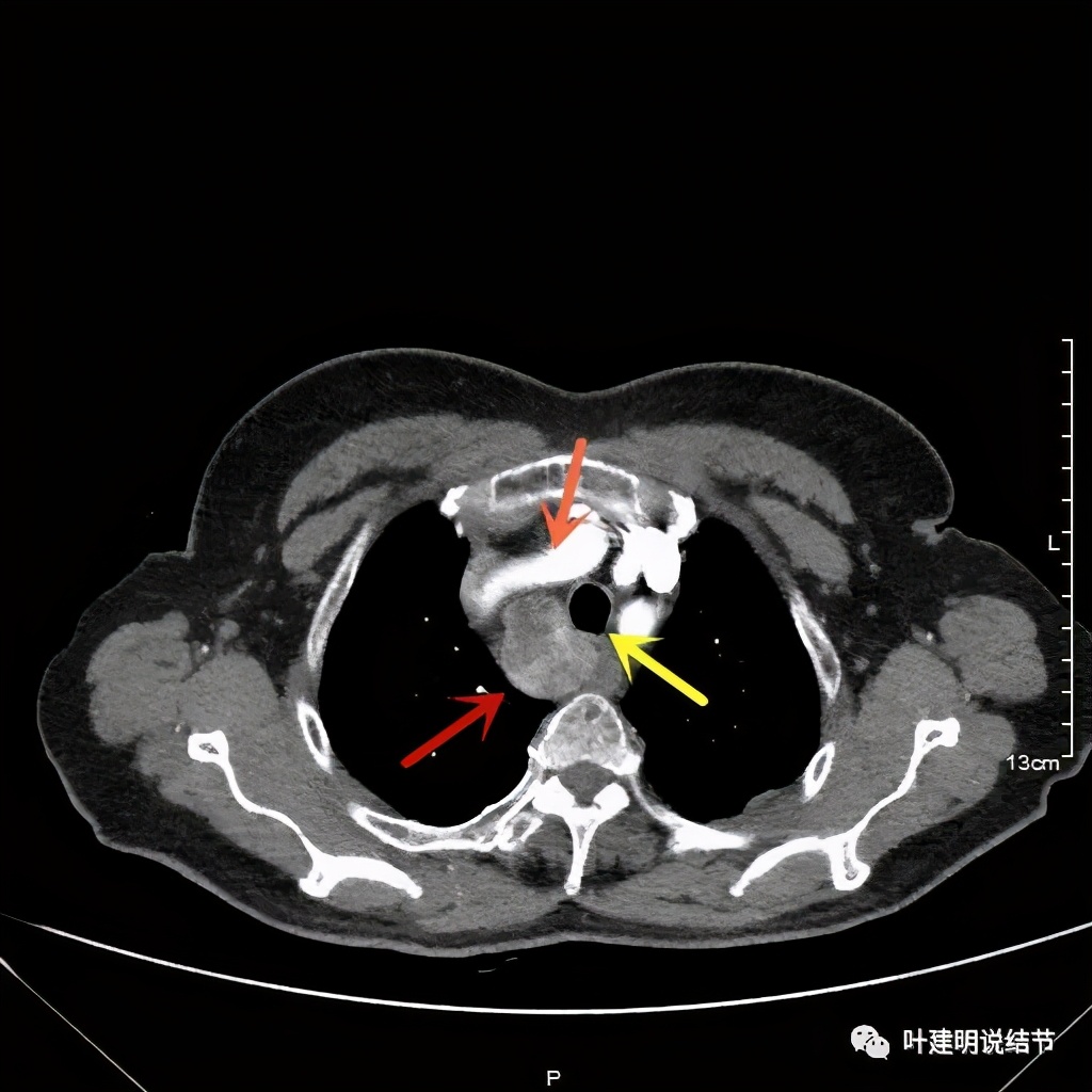 胸部高分辨ct检查注意事项,胸部ct扫描有没有危害