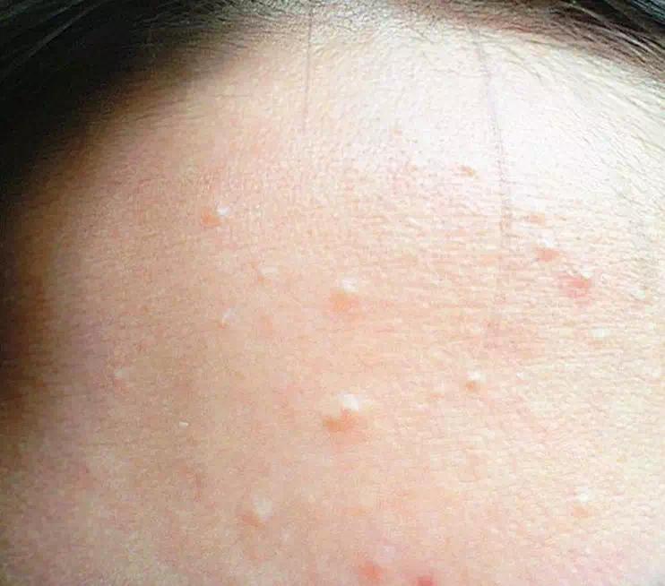 闭口怎么才能有效清理,闭口怎么处理最有效