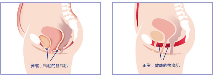 馨悦佳人盆底修复,馨悦佳人产后修复价格
