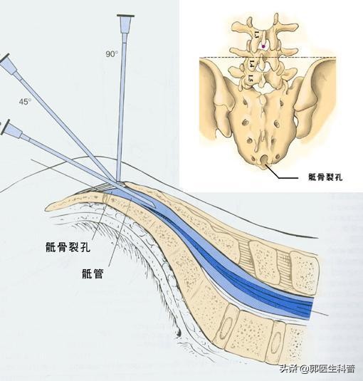 腰椎间盘突出术后复发的临床表现,极外侧型腰椎间盘突出容易复发吗