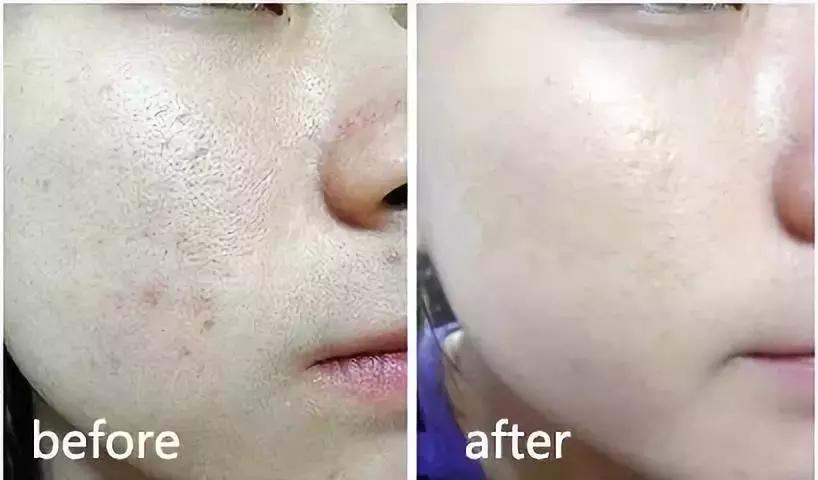 美白大创精华,大创美白精华