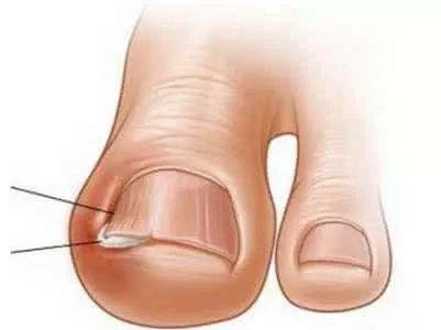 脚指甲两边向肉里扎,指甲小知识大全