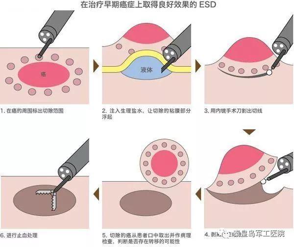 残胃得胃癌的机会大吗,残胃癌变的几率高吗