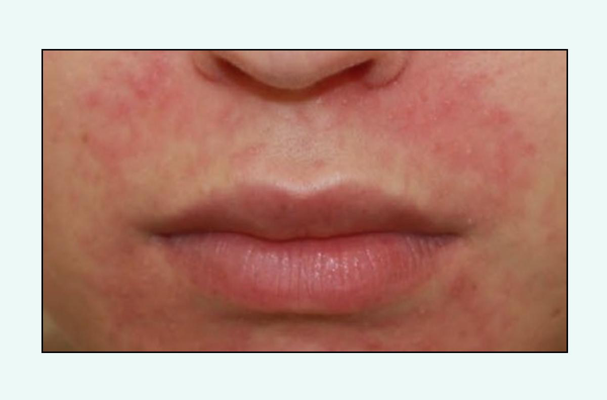 脸上的红疙瘩疼是什么原因,脸上的各种疙瘩