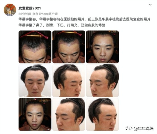 华晨宇被曝植发、整容，爆料者自称华晨宇老婆，还骂张碧晨是小三