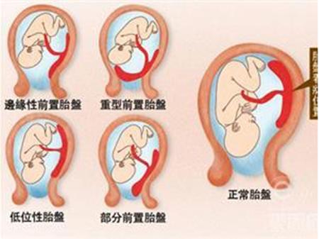 胎盘前壁与宫壁分界不清,胎盘前置跟前壁有区分吗