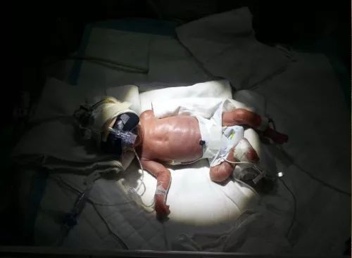 30周早产儿一天体重增加多少,30周早产2.5斤一切正常