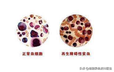 谢别录治疗白血病,谢别录治疗血液病效果怎么样