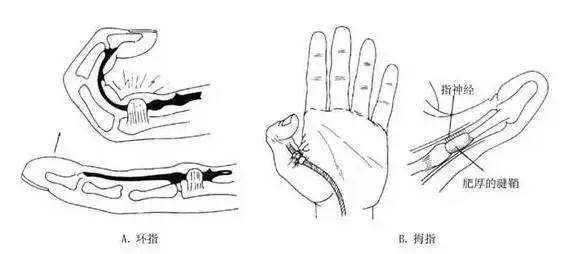 骨头咔咔响中医辨证,谈骨论筋肱骨