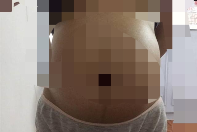 怀双胞胎初期小腹疼痛,女子怀孕要生了腹部疼痛