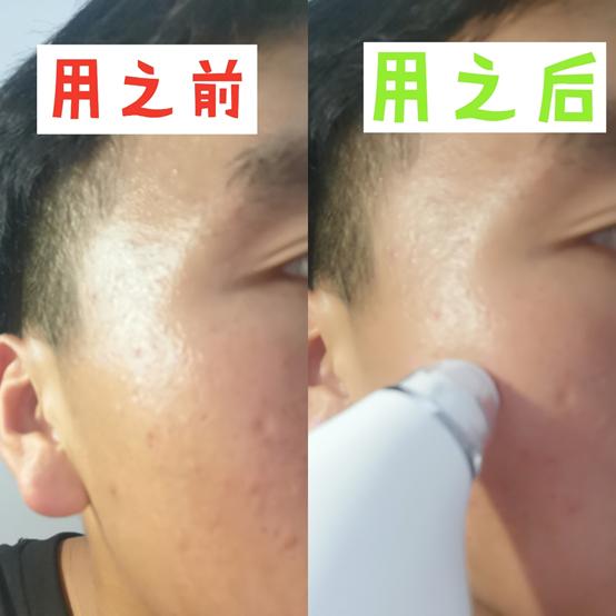 给男朋友第一次用黑头仪,皮肤居然这么脏,用完直呼:陈冠希