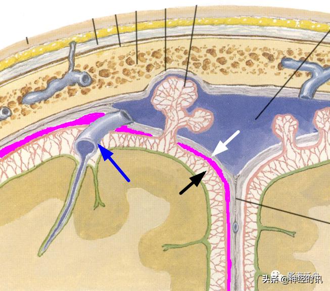 蛛血的临床表现,蛛血ct表现