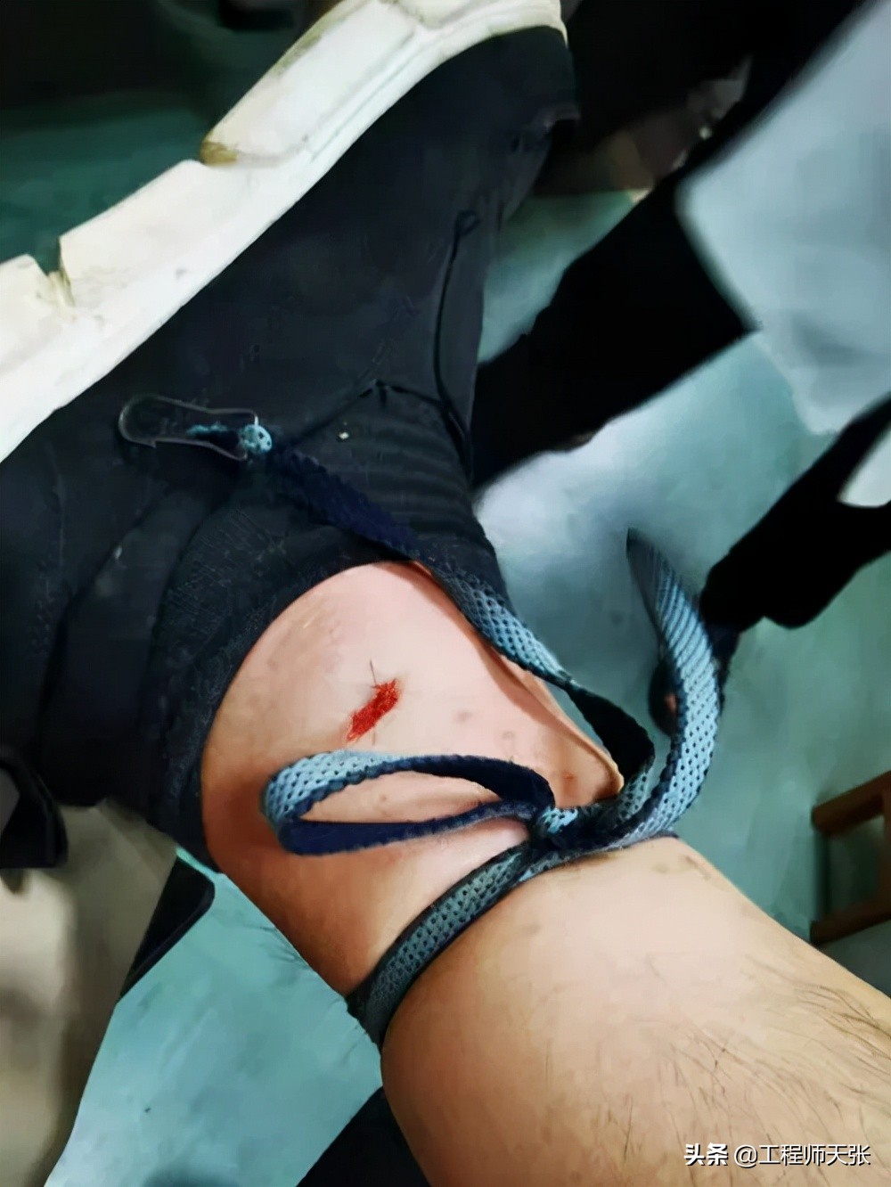 浙江男子走夜路被剧毒蛇咬，成功自救！做法实用，比教科书还经典