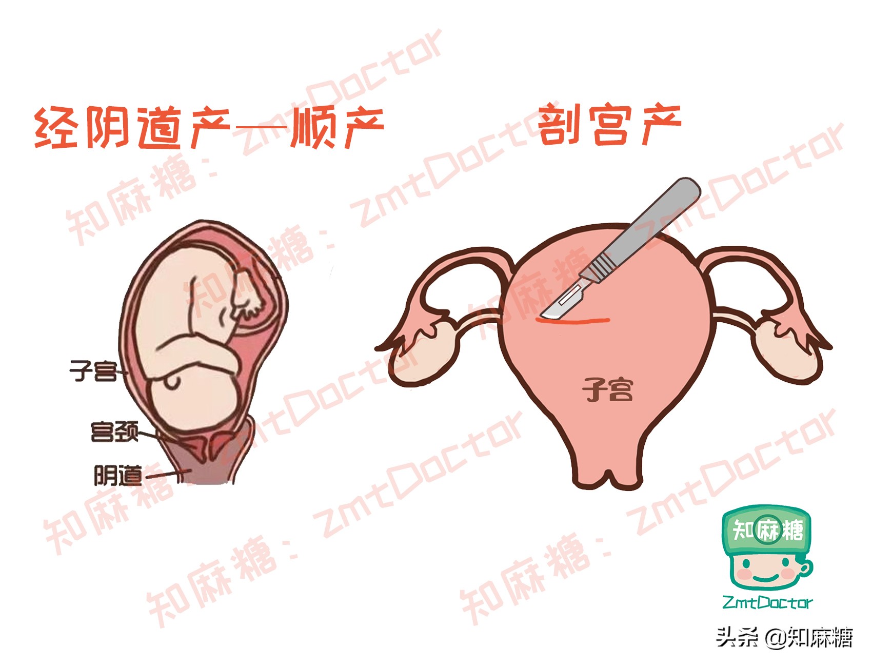 剖宫产又多了一宗罪，造成新生儿肠道菌群发育不良？