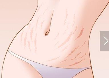 怎么做才能有效预防妊娠纹的出现,防止妊娠纹自己涂妊娠纹油