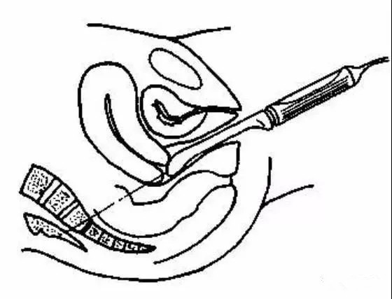 妇科阴式超声检查方法,盆底超声可检查什么疾病