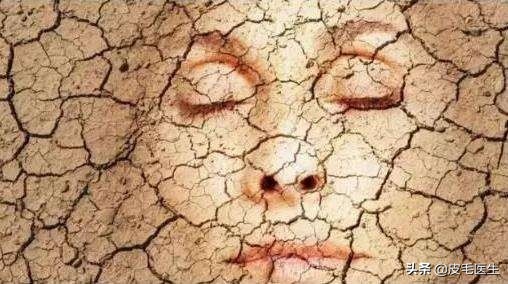 皮肤换季爆痘怎么办,皮肤换季干燥敏感爆痘怎么办