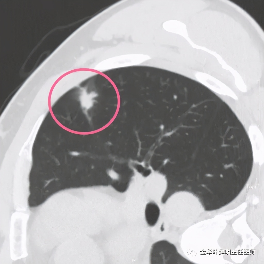 叶建明谈肺结节:一招分辨隐球菌性肉芽肿与肺癌