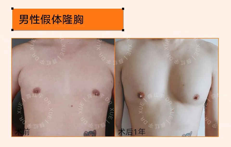 男性隆胸,男性隆胸后续