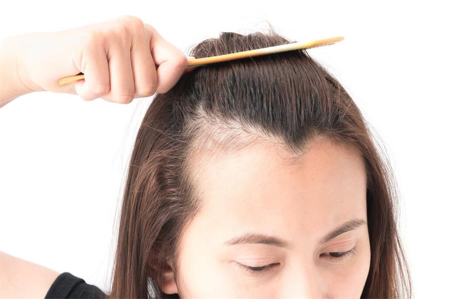 哺乳期脱发严重怎么治疗才有效,哺乳期脱发怎么办快速解决